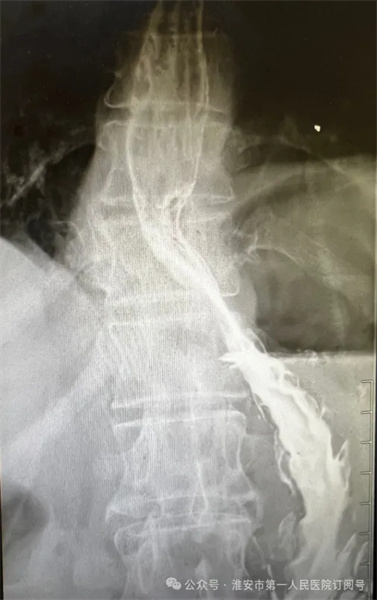 淮安市一院成功处理堵在患者“心底”的大石头——“胸腔胃”